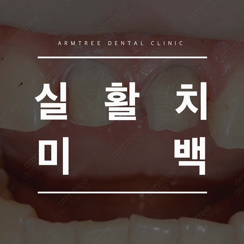 실활치미백 앞니변색 걱정없는 아름드리치과 관련 이미지 1