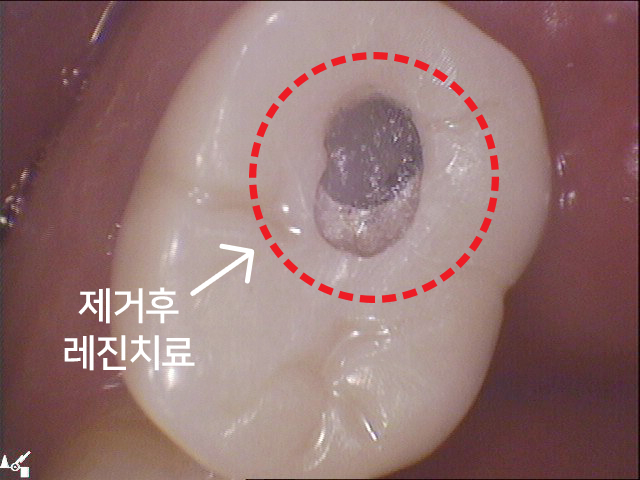 임플란트 구멍(홀)이 났는데 어떻하죠? 관련 이미지 8