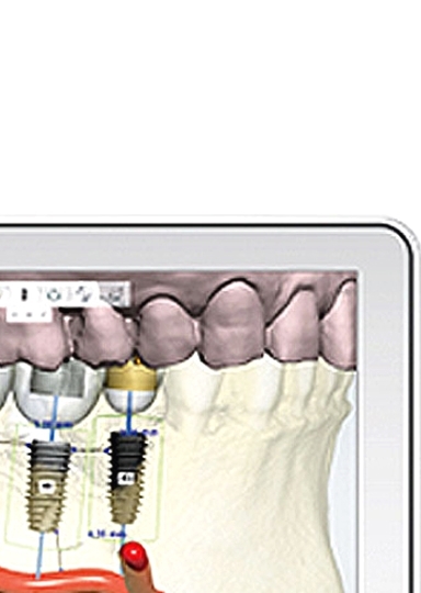 디지털임플란트 당일임플란트로 정확하고 안전하다면 관련 이미지 8