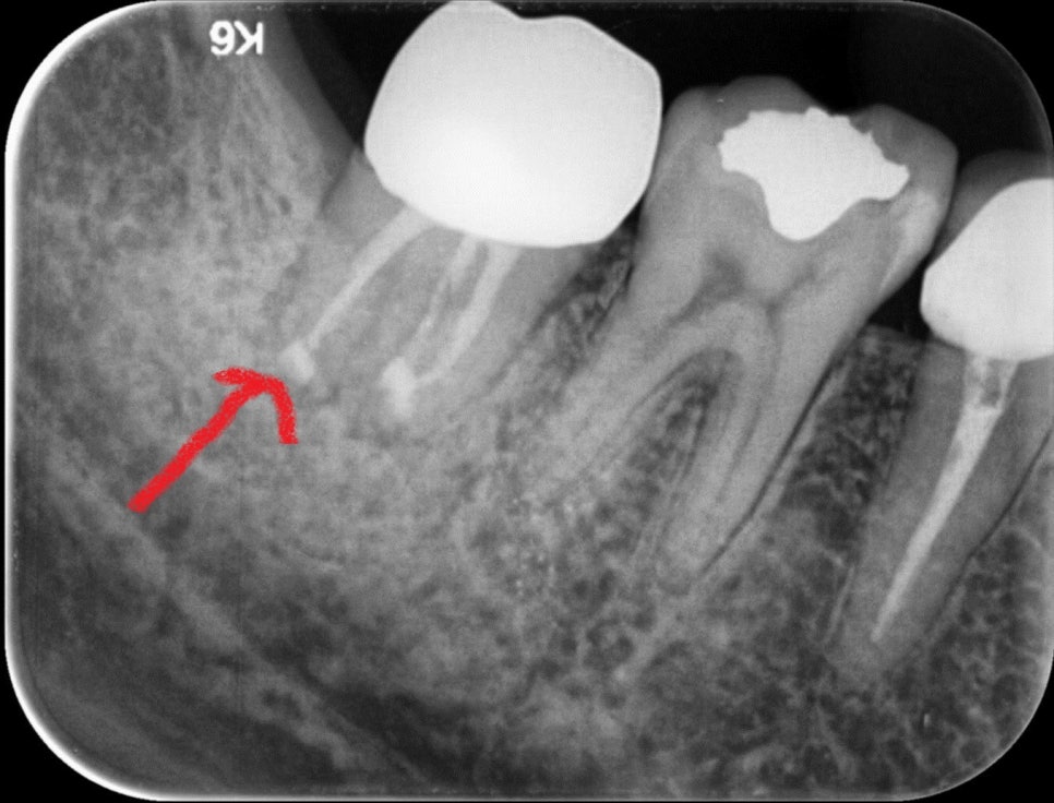 [신논현 치과] 임플란트 대신 치아재식(아름드리치과) 관련 이미지 10