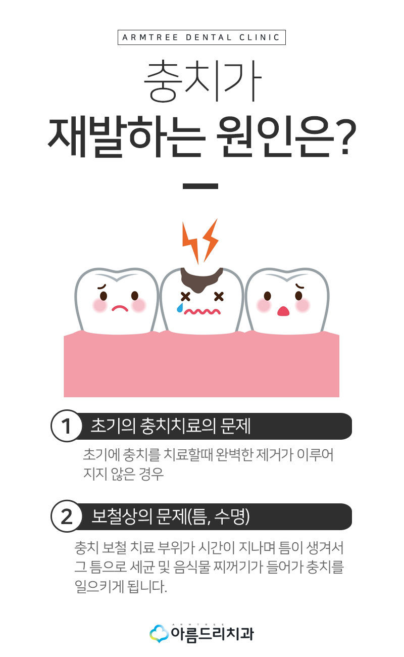 금니 2차충치 생기는 이유와 치료 관련 이미지 4