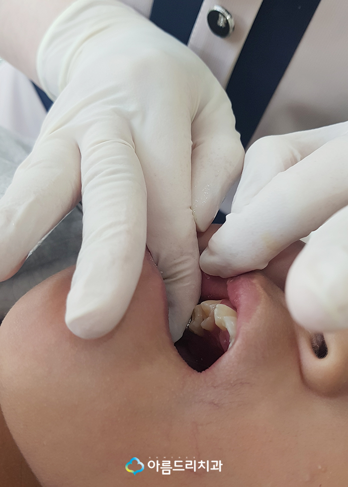 어린이치아교정 부정교합 RPE(급속구개확장장치) 악궁확장장치 관련 이미지 7