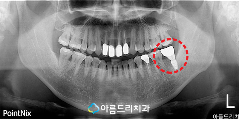 임플란트 구멍(홀)이 났는데 어떻하죠? 관련 이미지 3