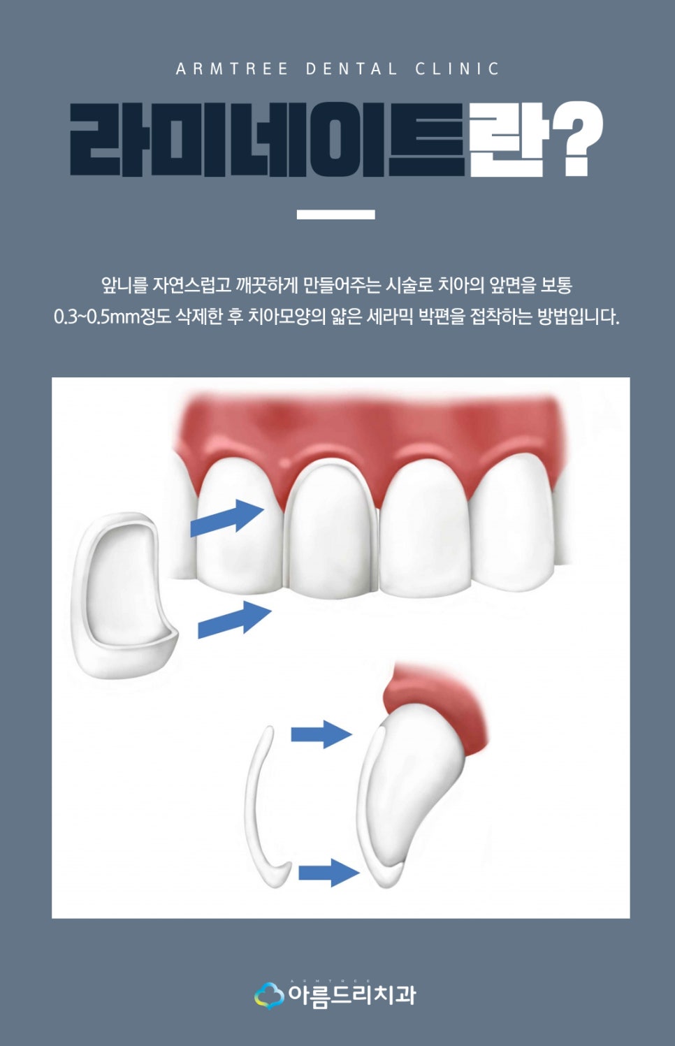 토끼이빨라미네이트 누런이 문제없음 관련 이미지 3