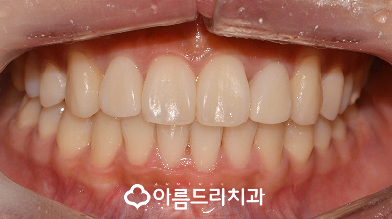 급속치아교정 코티코토미 피질골절단술 후기 관련 이미지 10