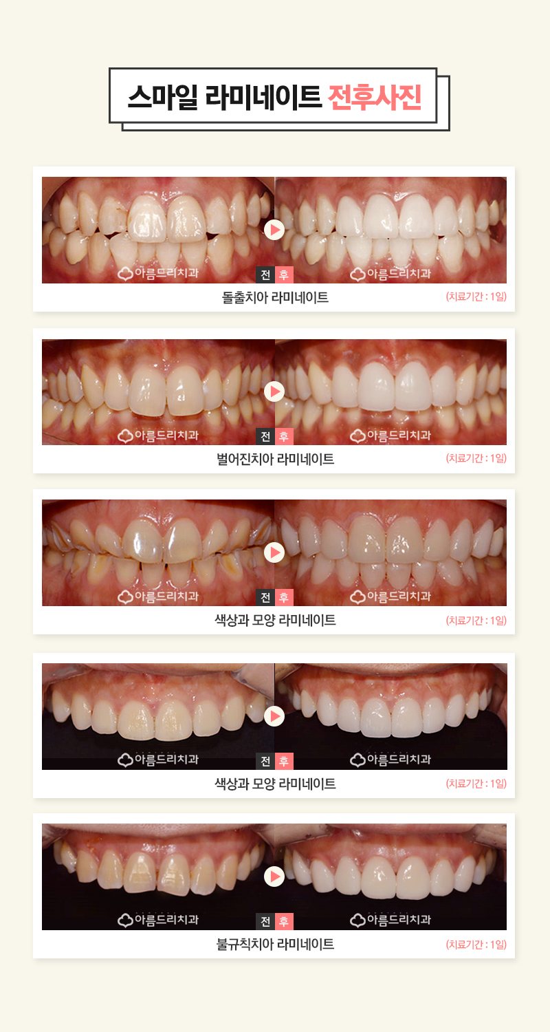토끼이빨라미네이트 입툭튀 정답은 관련 이미지 7