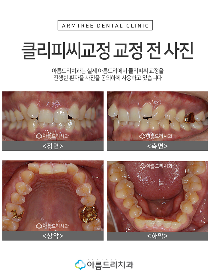 클리피시교정 덜아프고 빠르게 관련 이미지 3