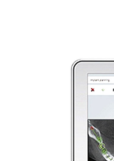 디지털임플란트 당일임플란트로 정확하고 안전하다면 관련 이미지 6