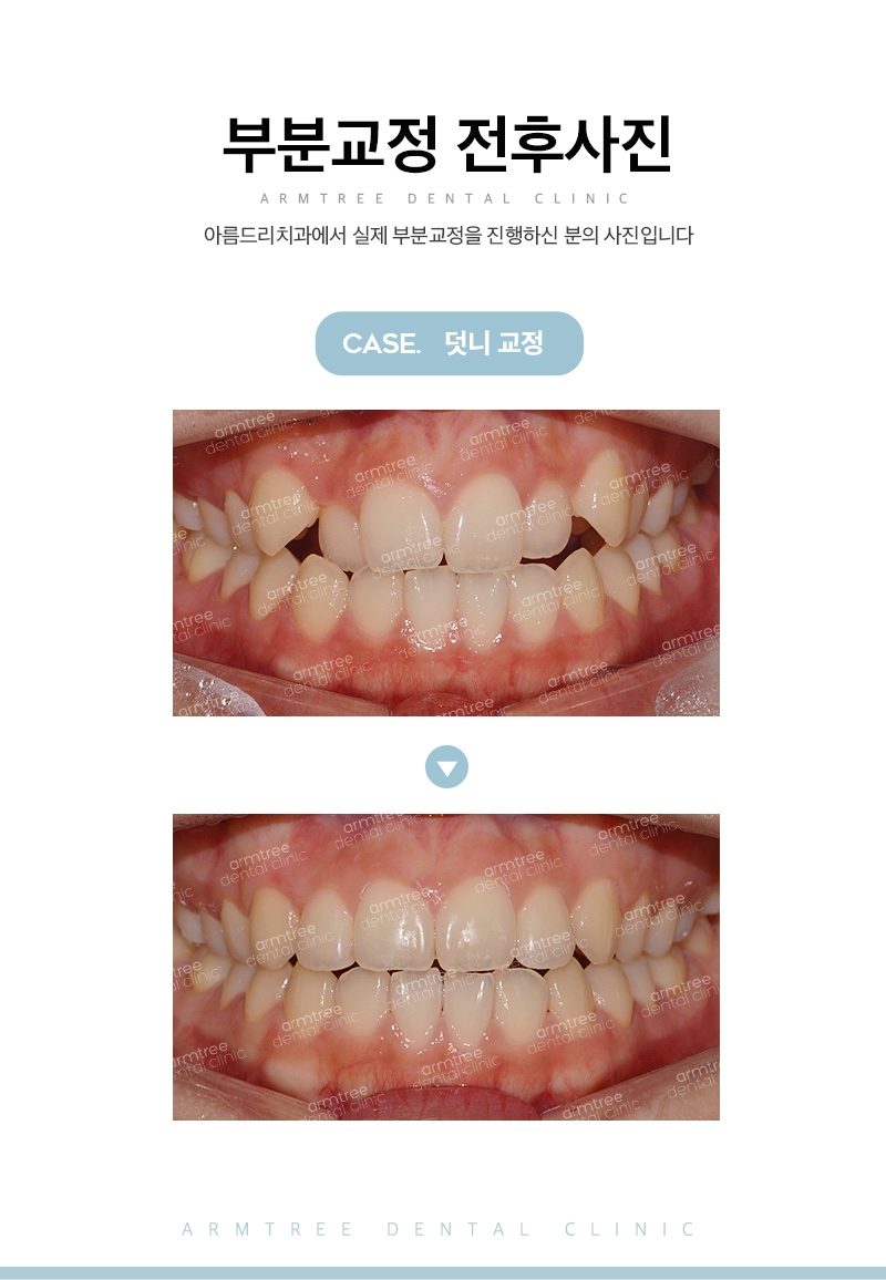부분교정기간 다양한후기 아름드리치과 관련 이미지 12