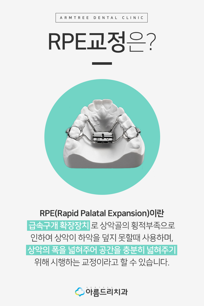 어린이치아교정 부정교합 RPE(급속구개확장장치) 악궁확장장치 관련 이미지 5