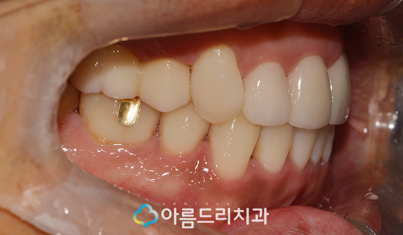 앞니 블랙트라이앵글 치아 이성형으로 해결 관련 이미지 11