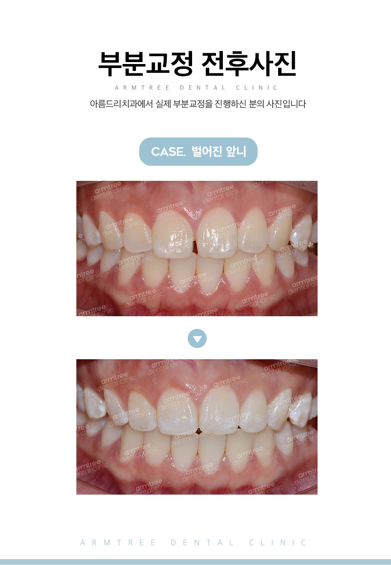 부분교정기간 부담된다면 단기간에 아름드리치과 관련 이미지 11