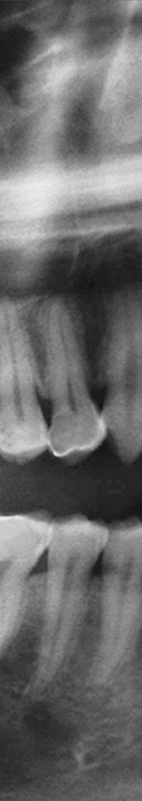 신논현역치과 사랑니 발치를 원한다면 관련 이미지 8