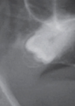 반포치과 전악임플란트는 풀아치 임플란트로 관련 이미지 5