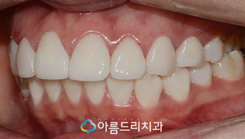 라미네이트부작용 걱정은노 관련 이미지 11