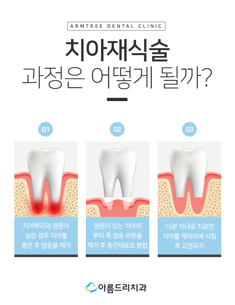 치아재식술 후기 자연치아지키기 관련 이미지 6