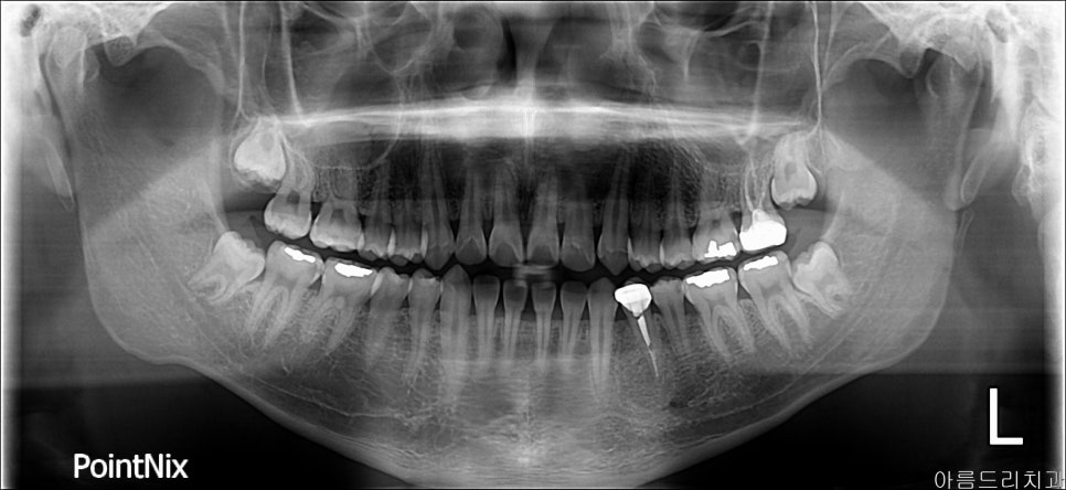 사랑니 뽑은 후 관리해야 하는 이유(신논현역치과) 관련 이미지 2