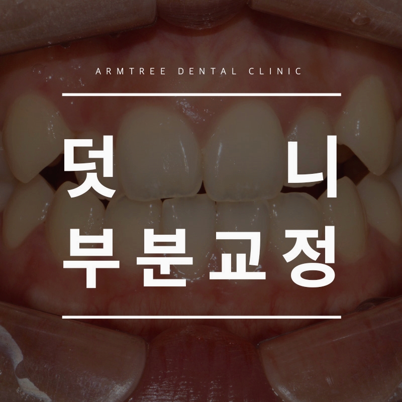 덧니부분교정으로 자연스러운미소 아름드리치과 관련 이미지 1