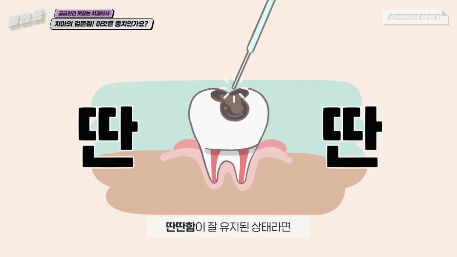 치아의 검은점 충치? 원인과 치료법! 아름드리치과 관련 이미지 4