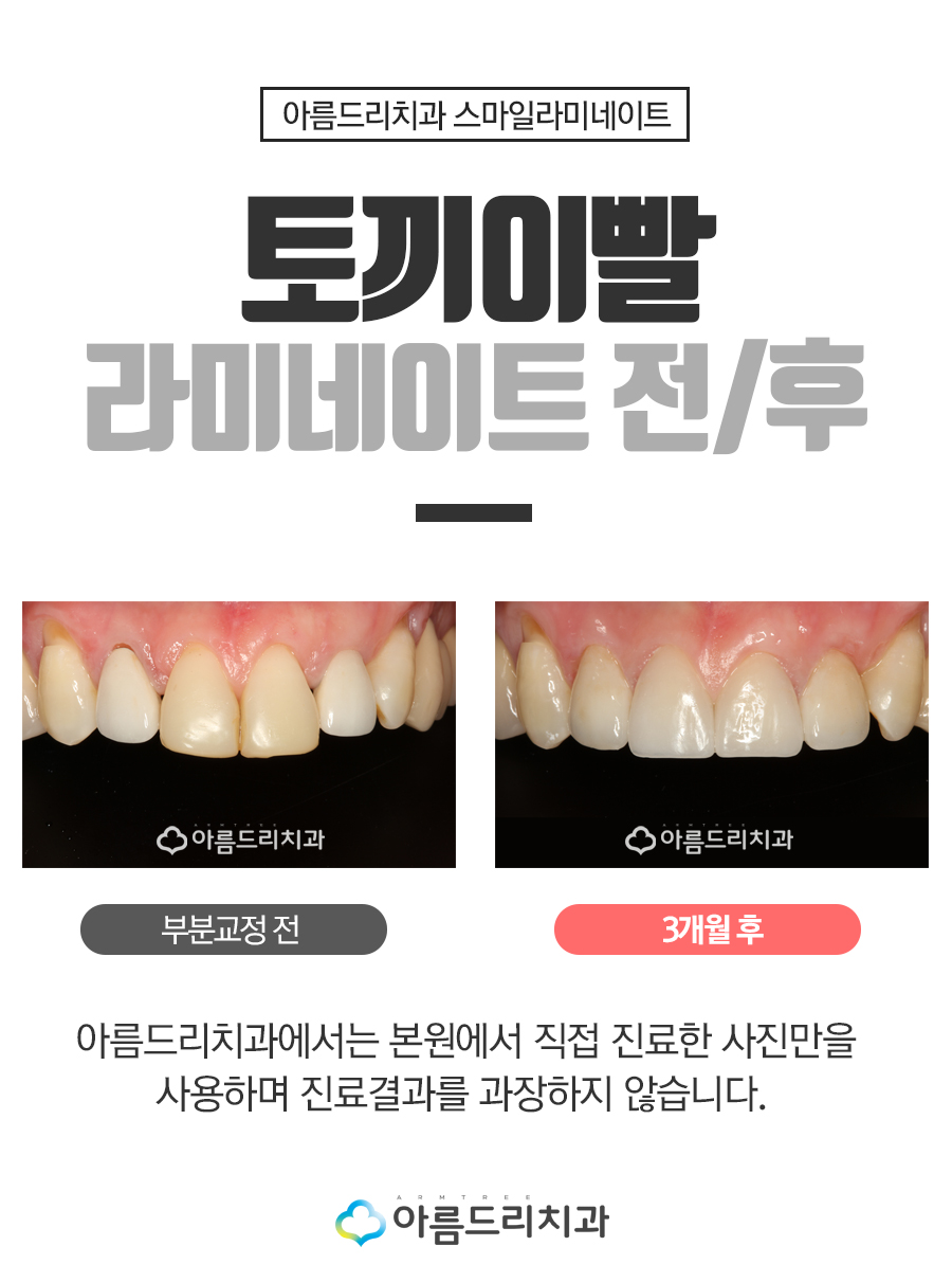 토끼이빨라미네이트 누런이 문제없음 관련 이미지 7