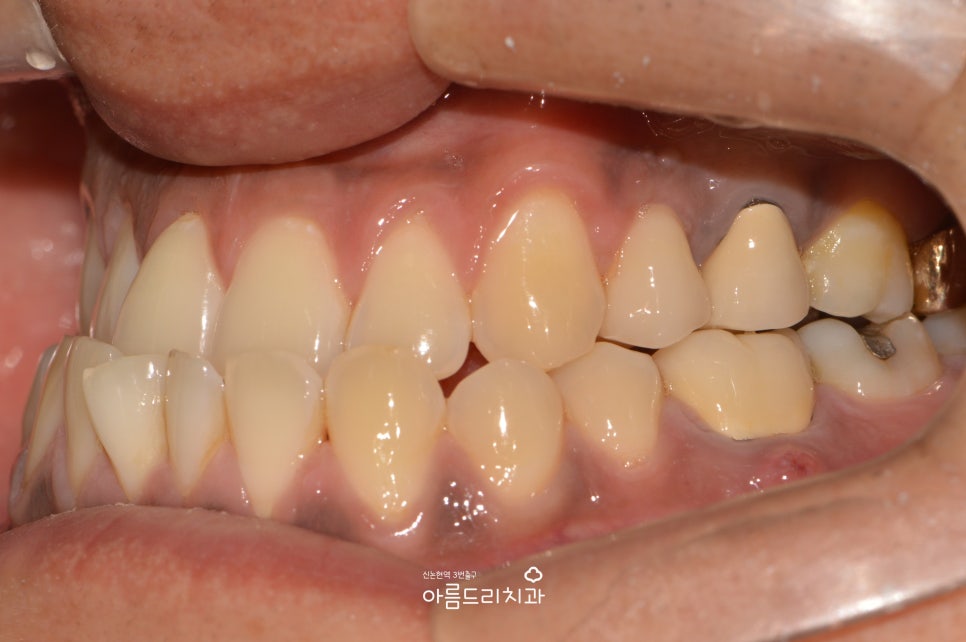 검은 잇몸! 잇몸미백으로 선홍빛 깨끗하게 관련 이미지 8