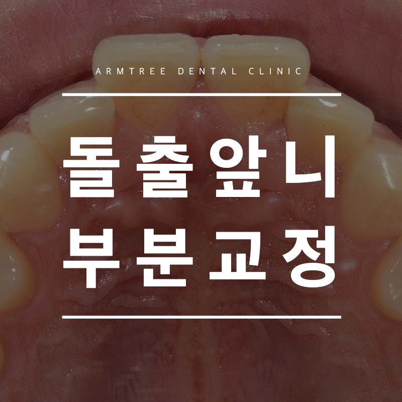 돌출앞니부분교정 빠르게 신논현역 아름드리치과 관련 이미지 1