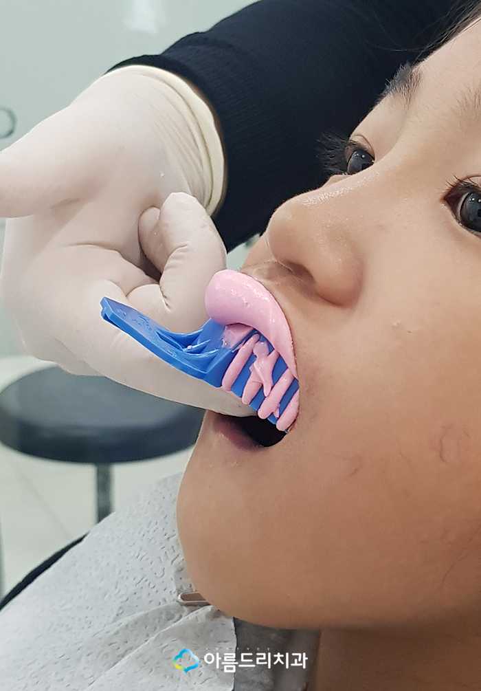 어린이치아교정 부정교합 RPE(급속구개확장장치) 악궁확장장치 관련 이미지 9