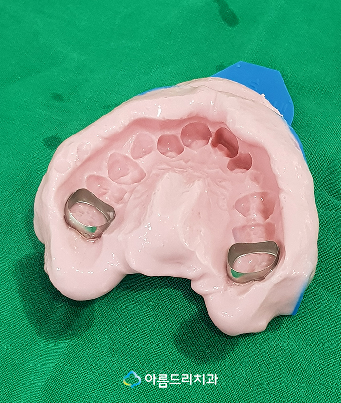 어린이치아교정 부정교합 RPE(급속구개확장장치) 악궁확장장치 관련 이미지 12