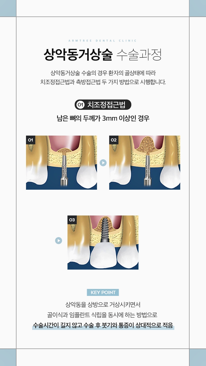 신논현치과 상악동거상술이 필요하다면 관련 이미지 4