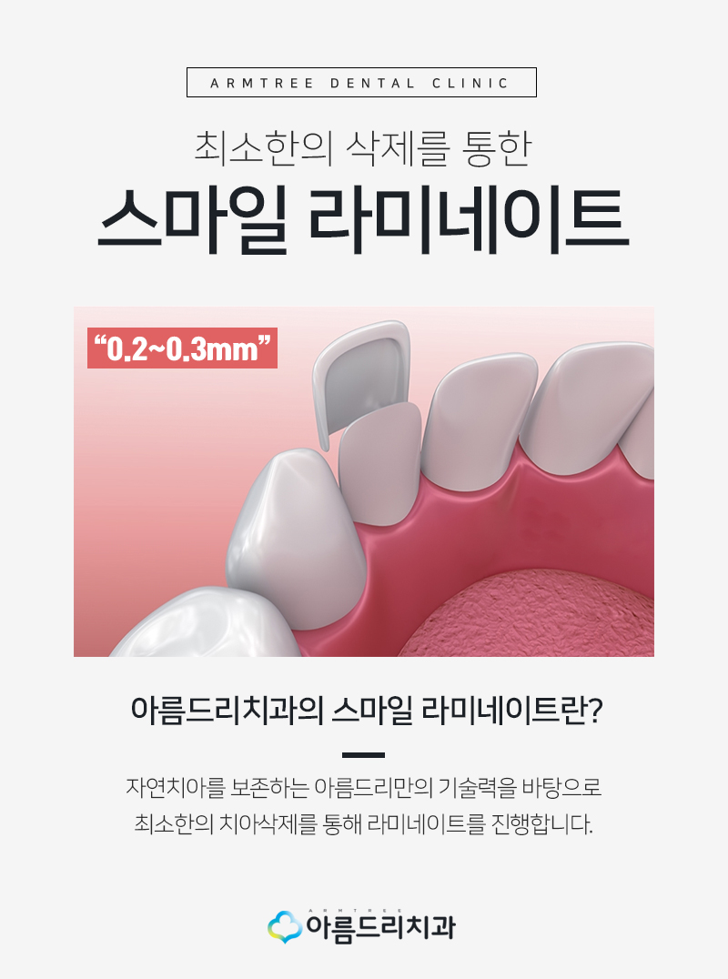 치아라미네이트 삭제량이 초중요 관련 이미지 6