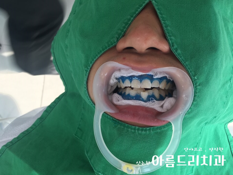 신논현역치과 아름드리치과에서 건강한 치아미백, 전문가 미백 관련 이미지 8