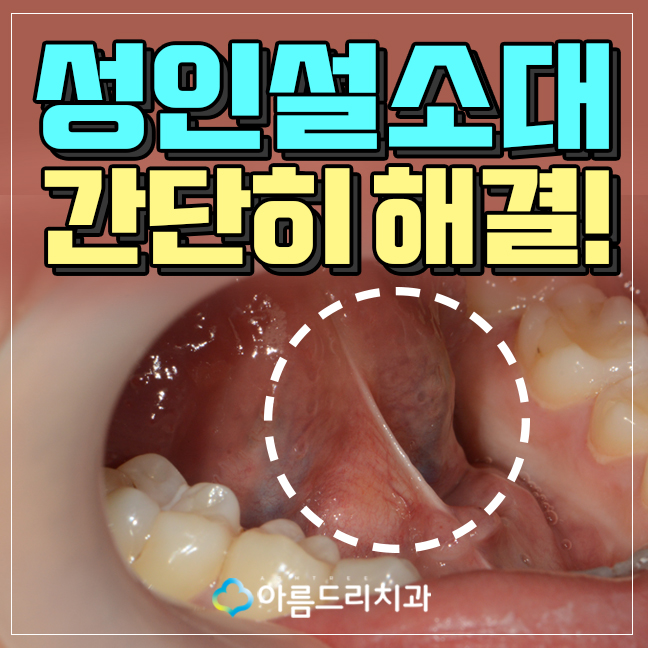 성인설소대수술 후기 단축증 해결 관련 이미지 1