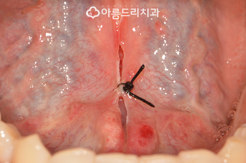 성인설소대수술 혀유착증 강남 바로알기 관련 이미지 10