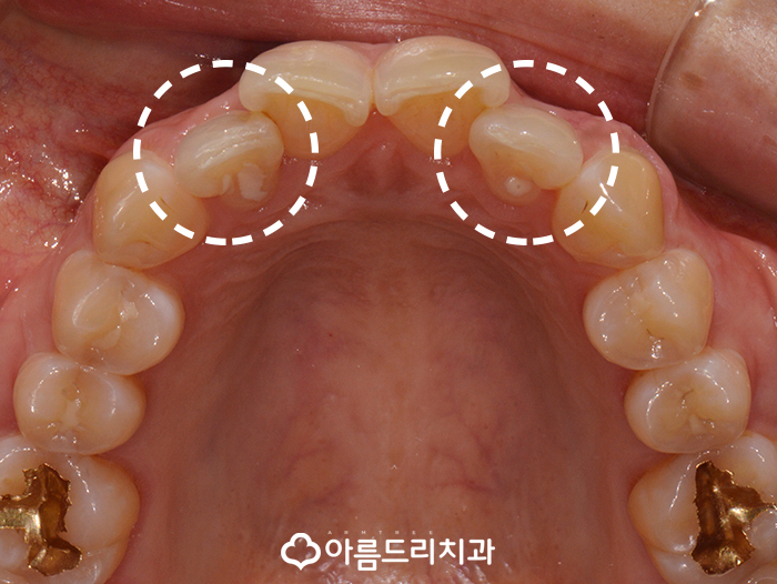 토끼이빨교정 앞니문제 해결 관련 이미지 4