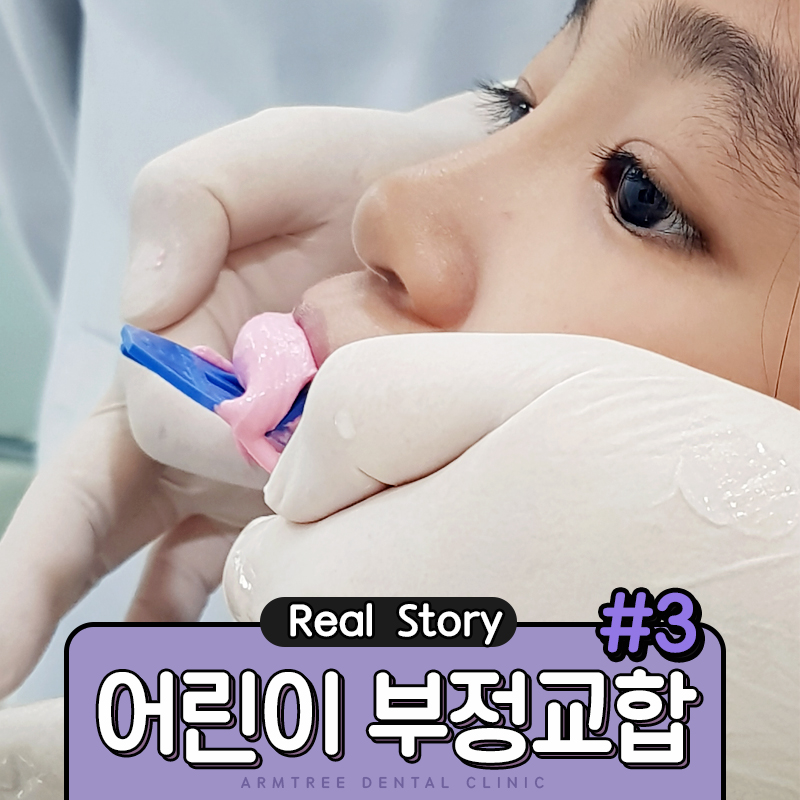 어린이치아교정 부정교합 RPE(급속구개확장장치) 악궁확장장치 관련 이미지 1