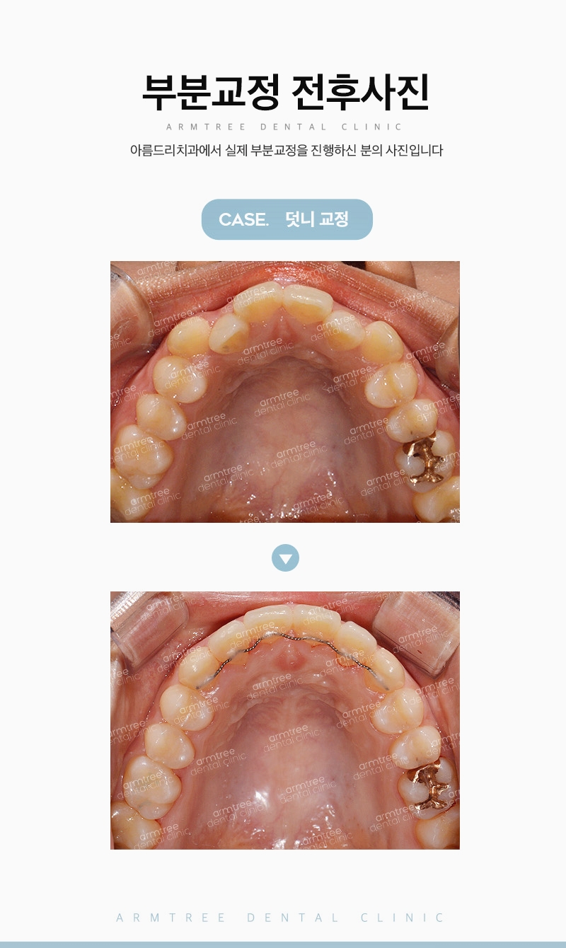 덧니부분교정후기 3~6개월만에 가능하다면 관련 이미지 11