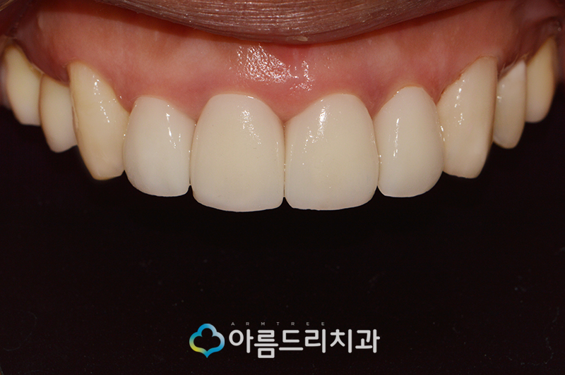 앞니 블랙트라이앵글 치아 이성형으로 해결 관련 이미지 8