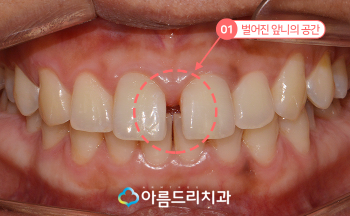 앞니벌어짐 부분교정으로 빠르게 관련 이미지 3