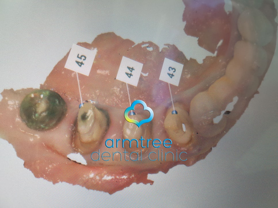 아름드리치과 이현정원장의 치료 이야기- 라미네이트란? 관련 이미지 8