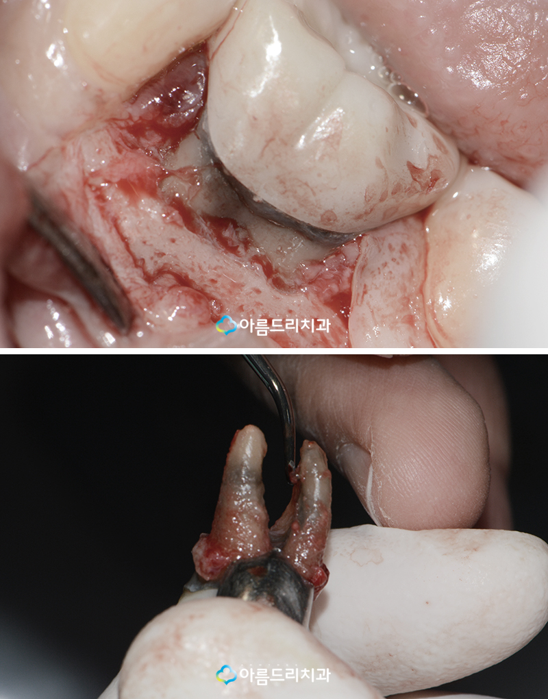 치아재식술 치료후기 자연치아살리기 관련 이미지 4