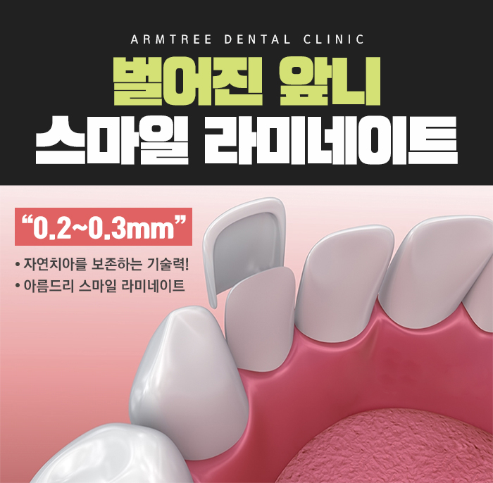 치아벌어짐 치아교정사랑니 아름드리 관련 이미지 6