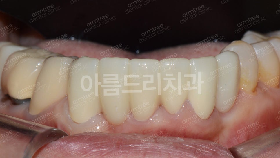 임플란트가 무조건 최선은 아니다! 아름드리치과 진료일기 관련 이미지 11