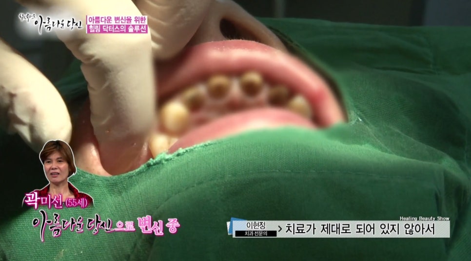 이현정원장의 아름다운 당신 시즌 1(4회 곽미선 도전자)신경치료, 심미보철, 보철치료, 올세라믹 관련 이미지 4