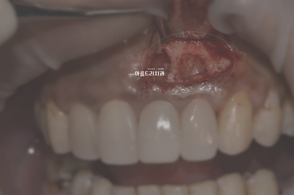 뽑지 않고 자가치아를 살려주세요_치아 뿌리수술_치근단절제술+뼈이식 관련 이미지 3