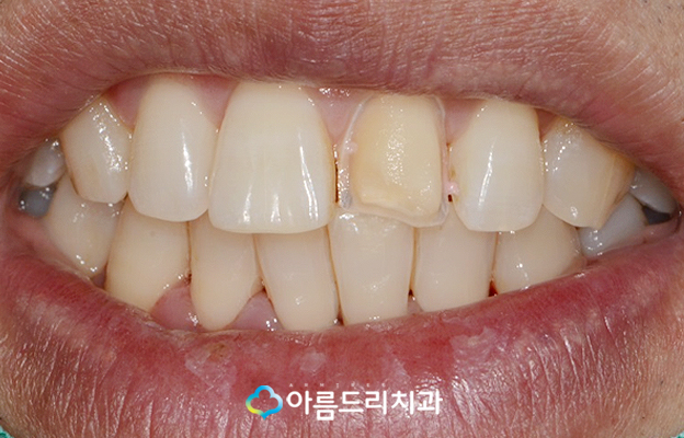 앞니깨짐 치료 최소삭제라미네이트 리얼후기 관련 이미지 7