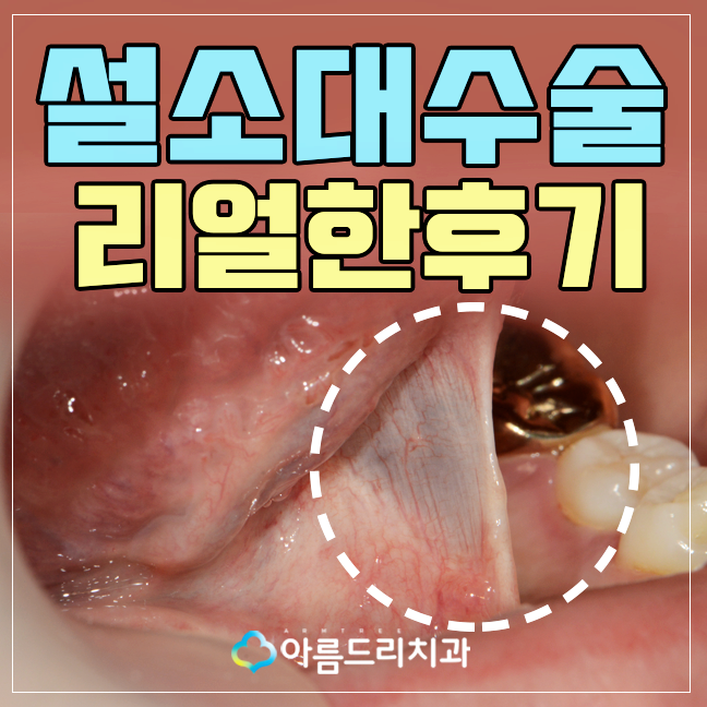 설소대단축증 - 단설소대증의 치료과정 관련 이미지 1