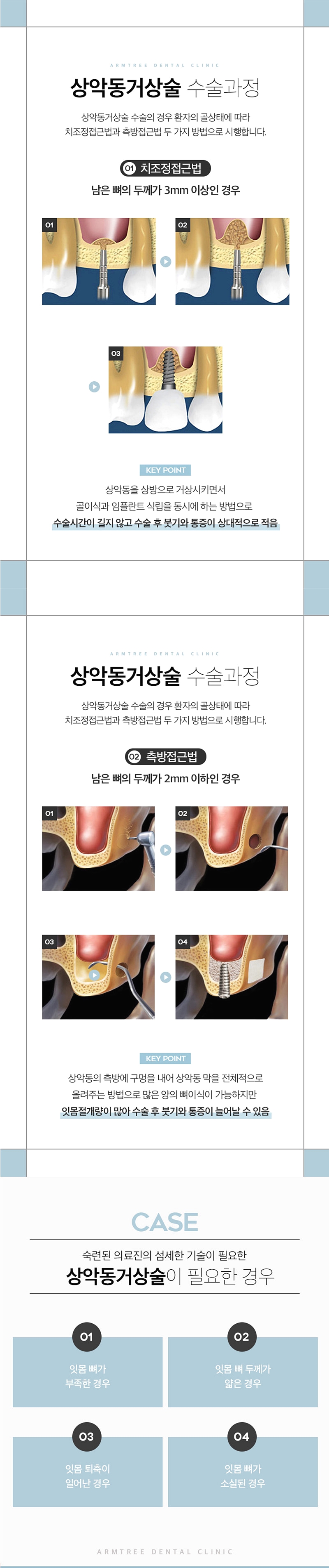 신논현역임플란트 아름드리치과에서 상악동거상술이 필요하면 관련 이미지 2