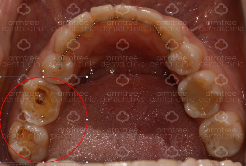 [치아 신경치료] #46,47번(오른쪽 아래 치아) 통증으로 내원 관련 이미지 4
