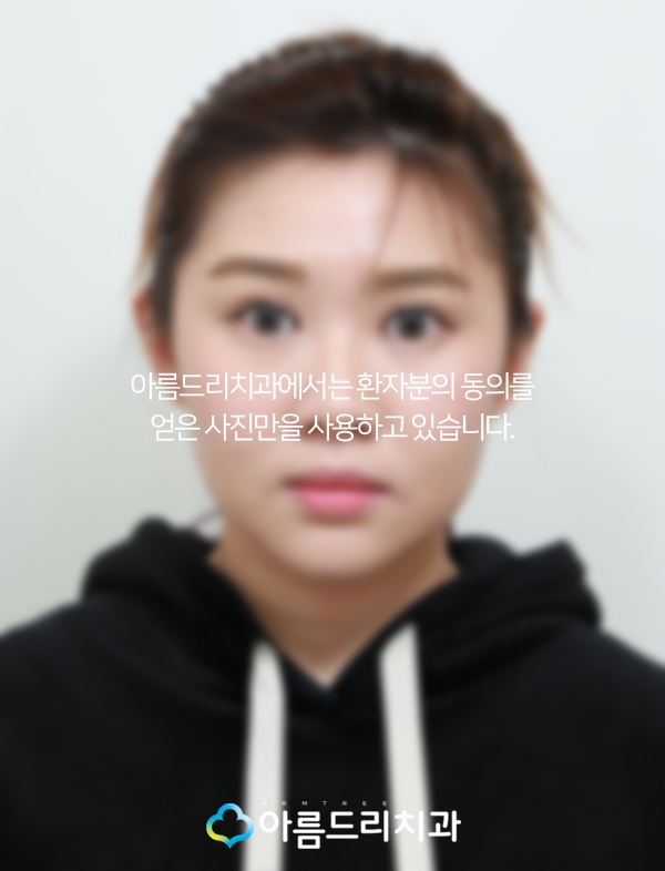 벌어진앞니 앞니라미네이트 치료후기 관련 이미지 3