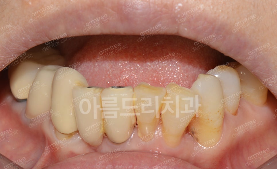 임플란트가 무조건 최선은 아니다! 아름드리치과 진료일기 관련 이미지 8